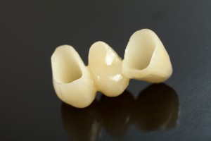 Dental Bridge