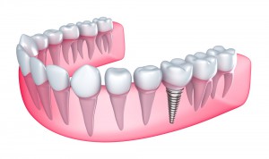 dental implant