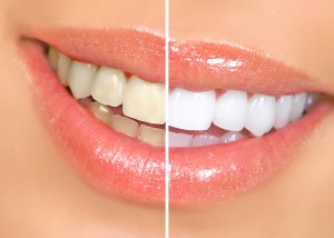 teethwhiteningdental